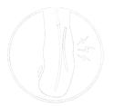 Over Pronation